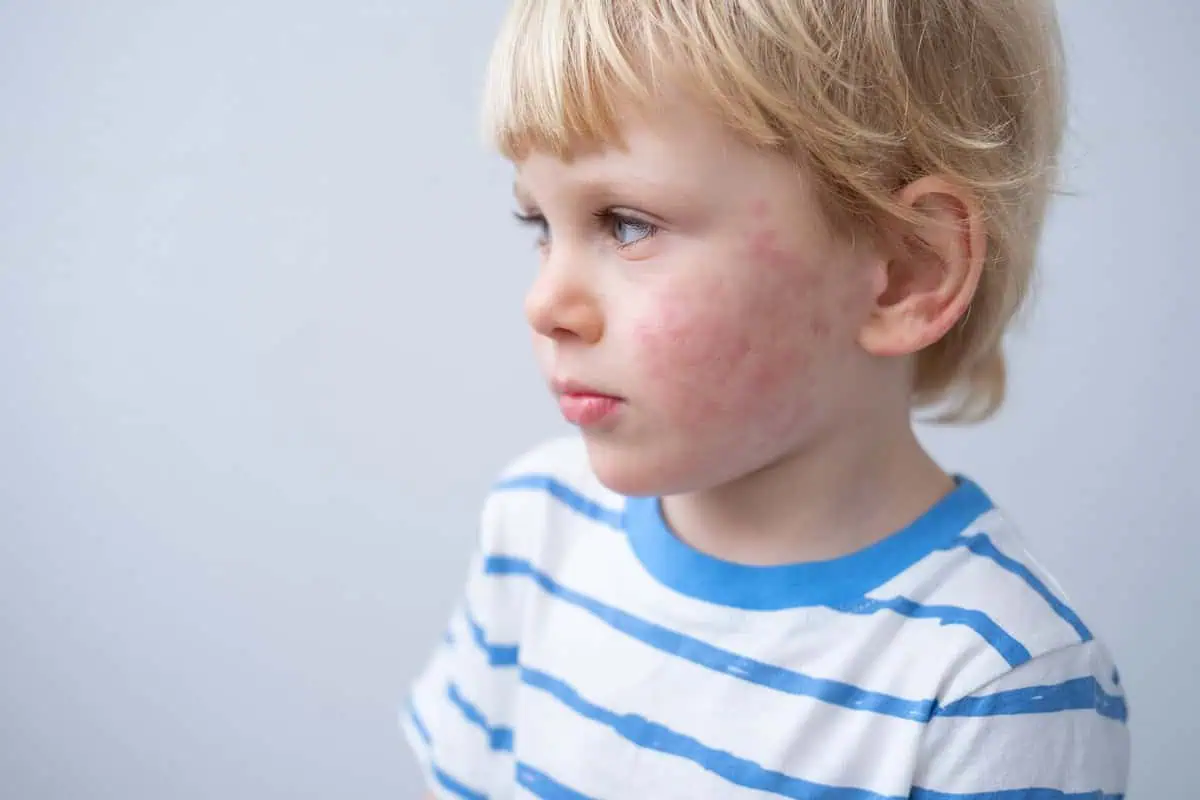 eczema treatment for chidren