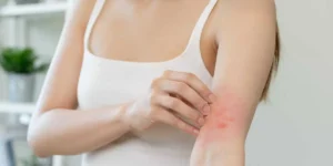Eczema and atopic allergy virtual treatment in USA