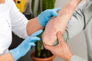 Eczema Relief Starts Here How Personalized Plans Make a Difference