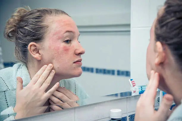 What is Eczema