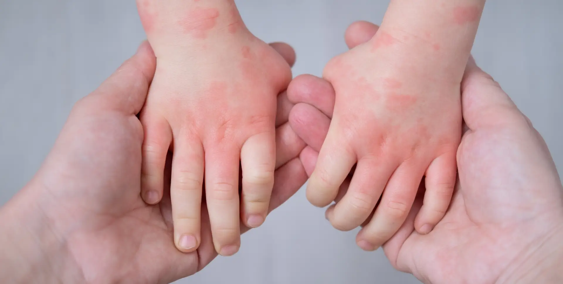 Dust Mite allergy virtual treatment in USA